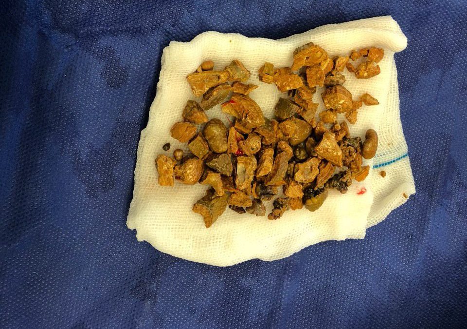 جراحی PCNL توسط دکتر طباطبایی